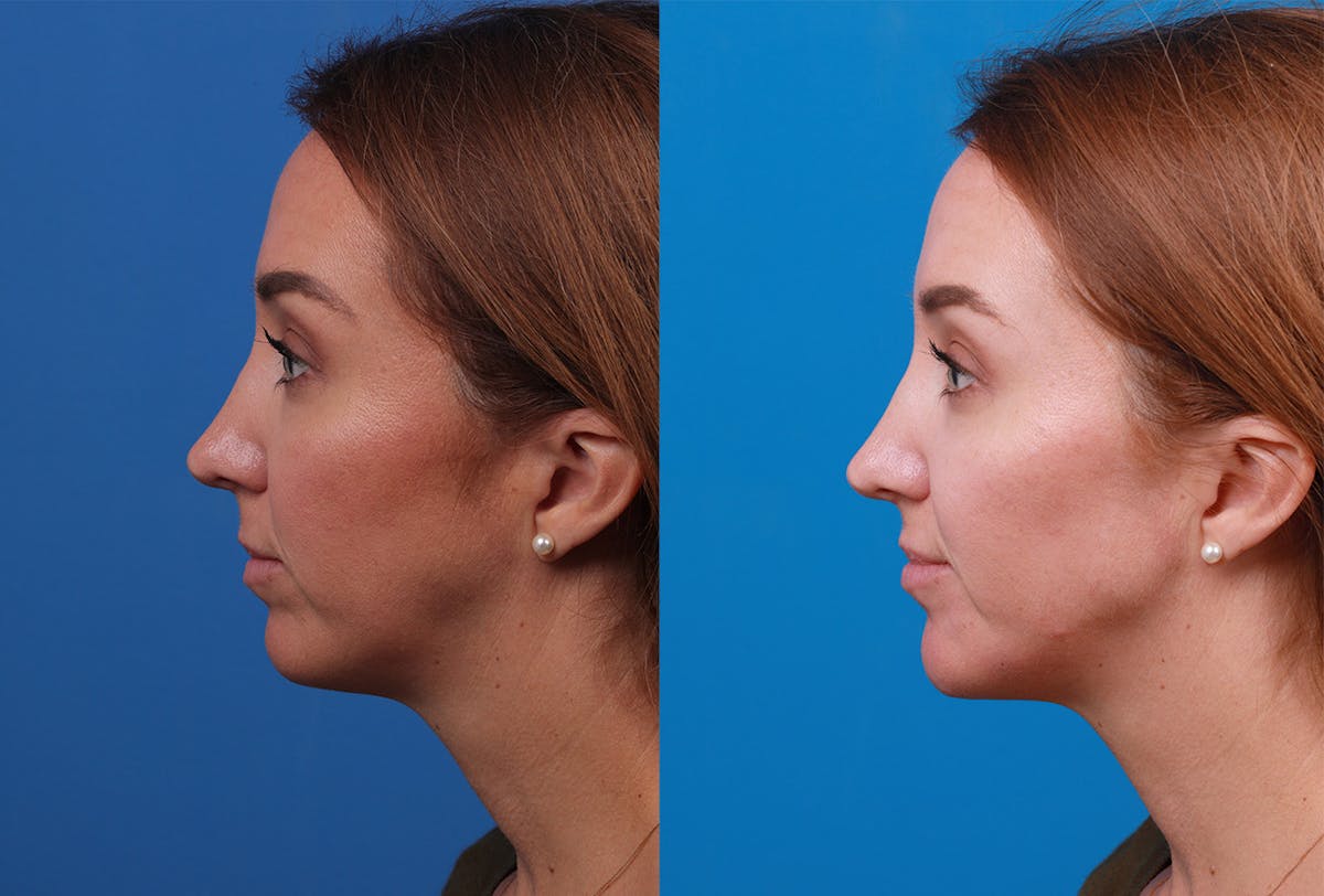 Dermal Fillers Before & After Gallery - Patient 147033474 - Image 5