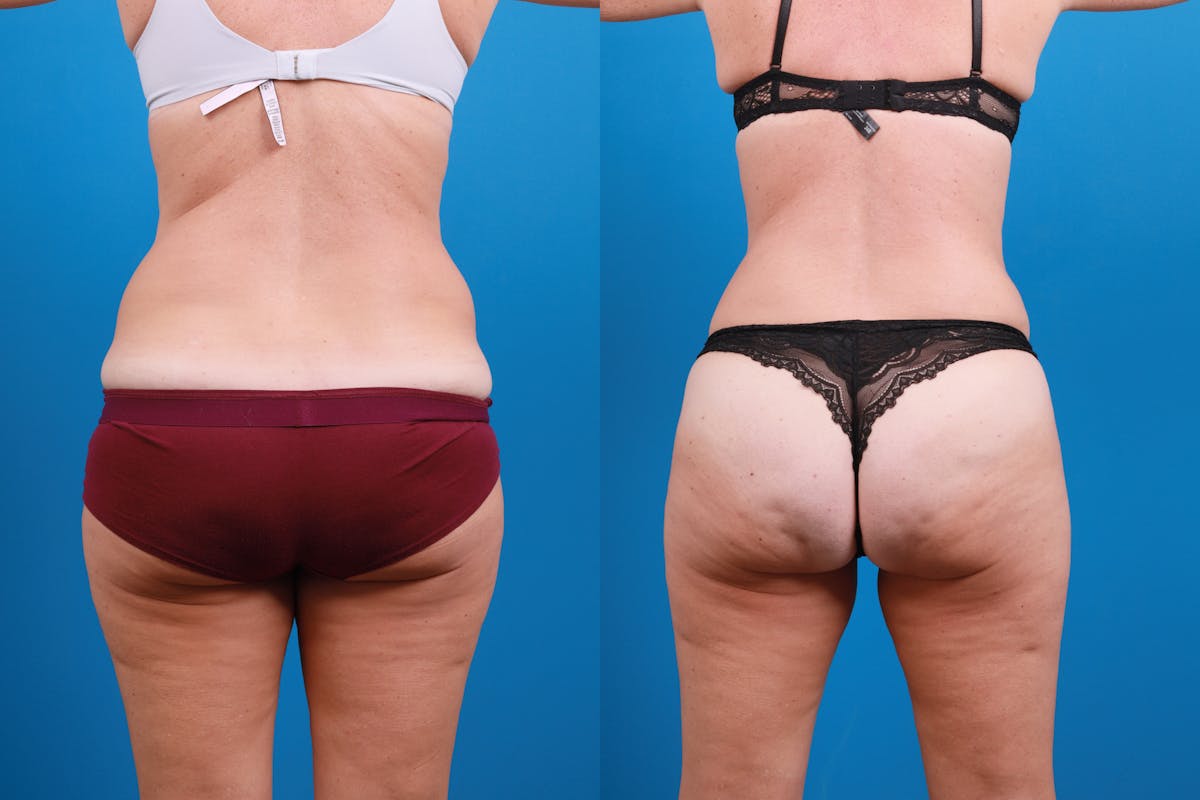 Tummy Tuck Before & After Gallery - Patient 139157 - Image 9