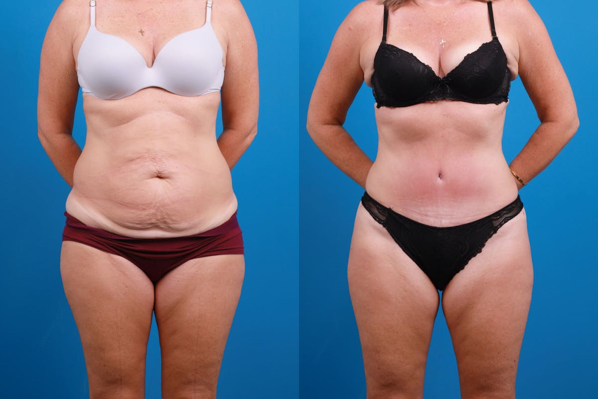 Tummy Tuck Before & After Gallery - Patient 147415881 - Image 1