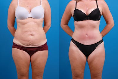 Tummy Tuck Before & After Gallery - Patient 147415881 - Image 1