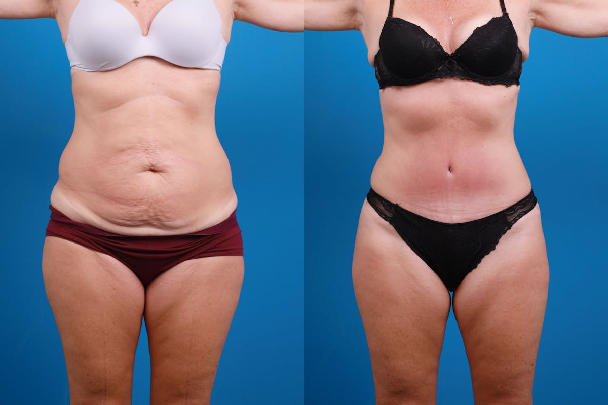 Tummy Tuck Before & After Gallery - Patient 139157 - Image 2
