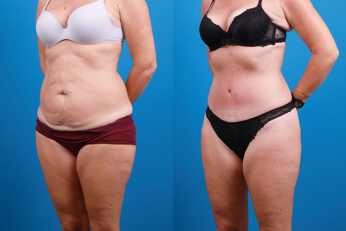 Tummy Tuck Before & After Gallery - Patient 139157 - Image 6