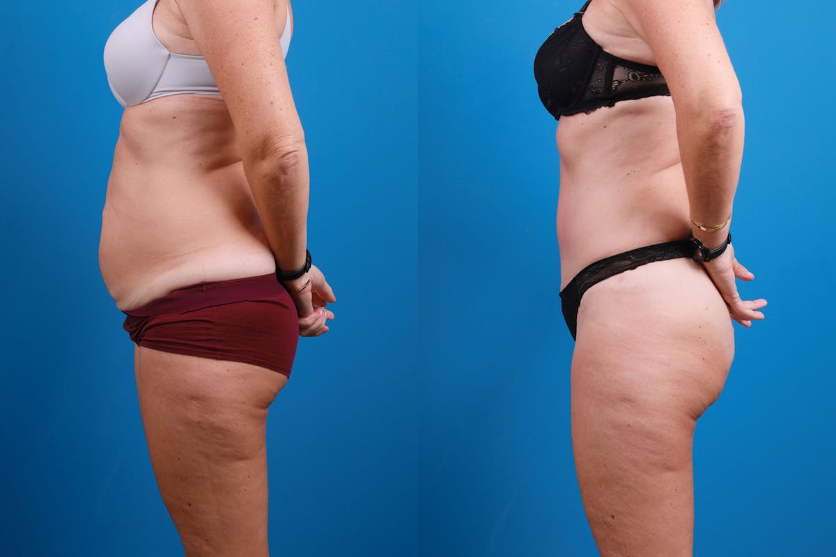 Tummy Tuck Before & After Gallery - Patient 139157 - Image 7