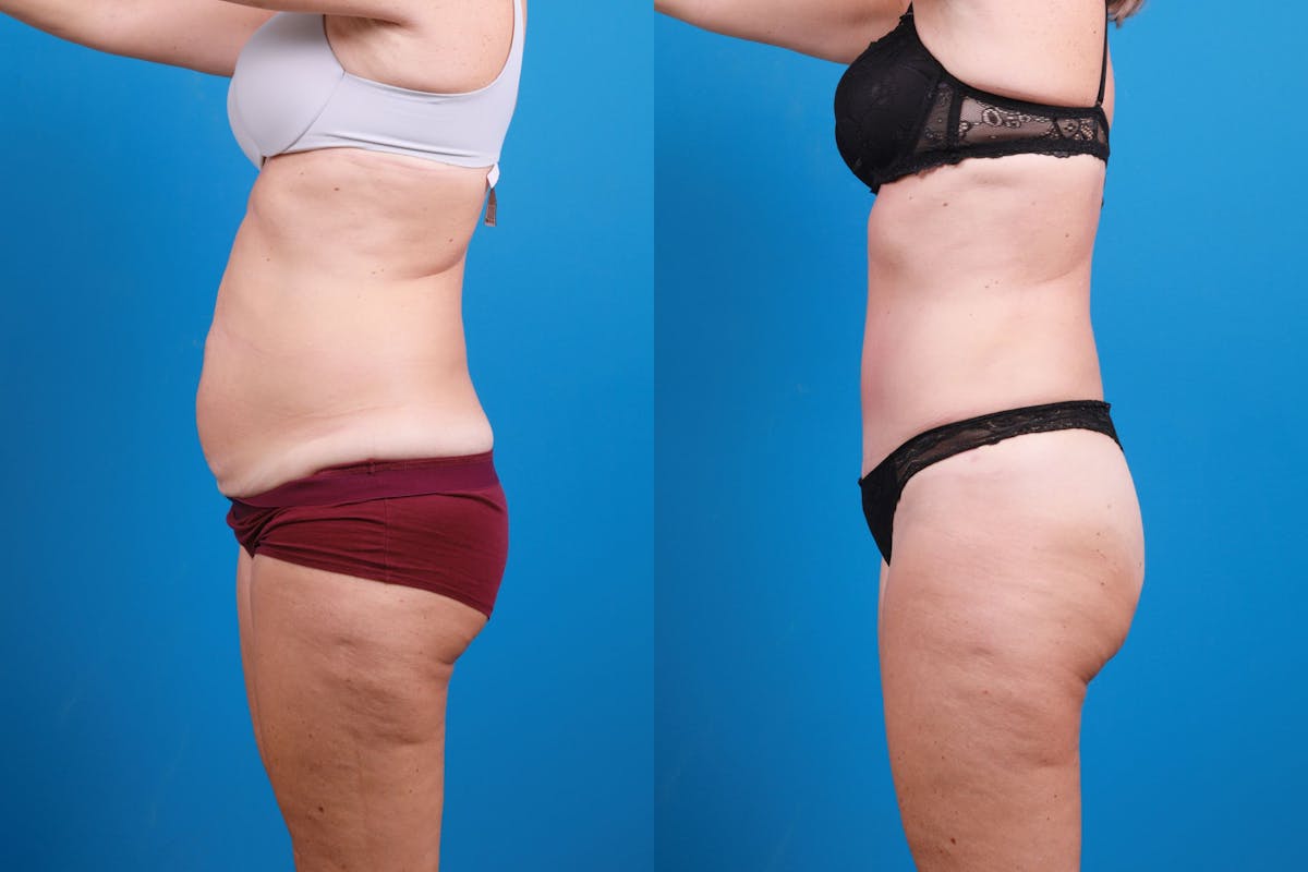Tummy Tuck Before & After Gallery - Patient 139157 - Image 8