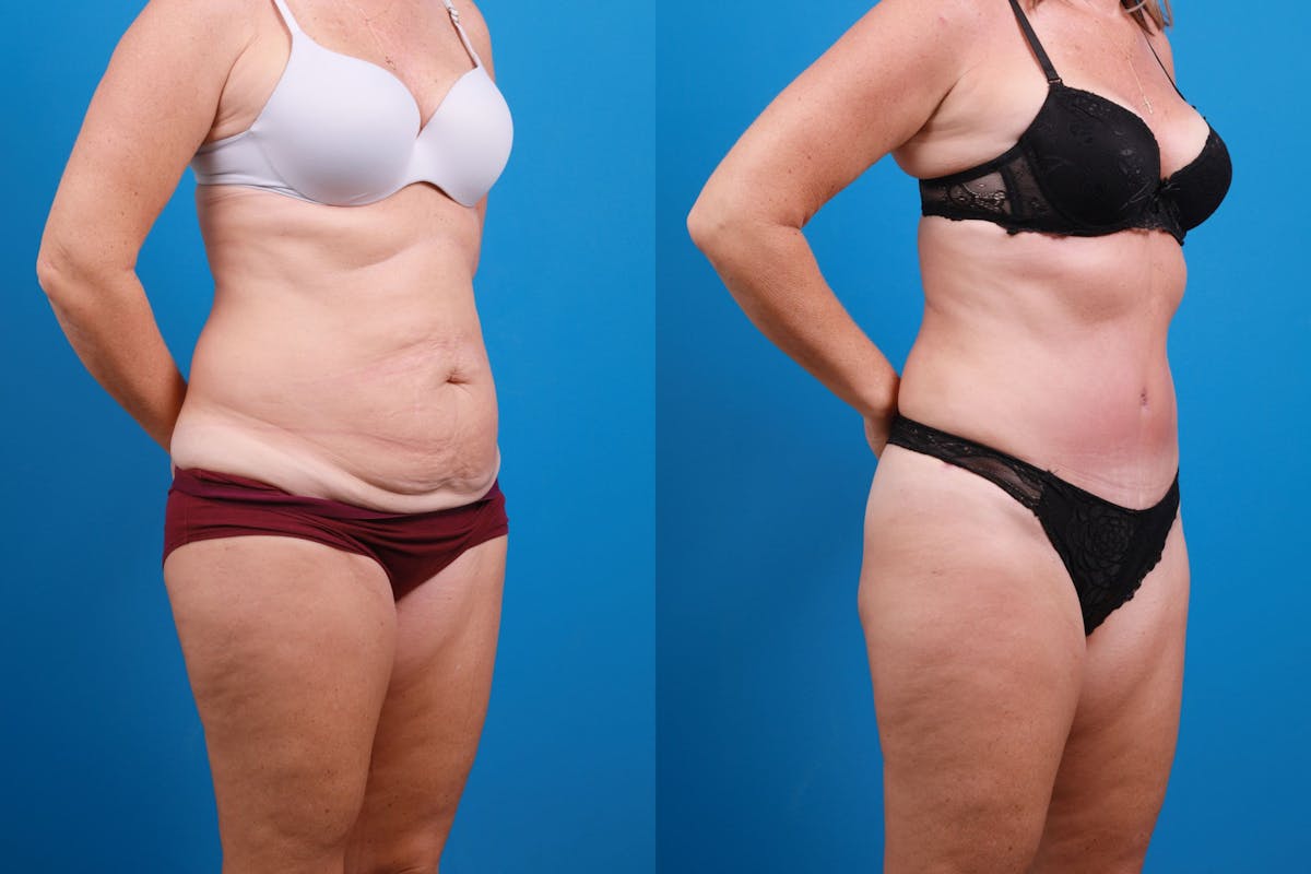 Tummy Tuck Before & After Gallery - Patient 139157 - Image 3