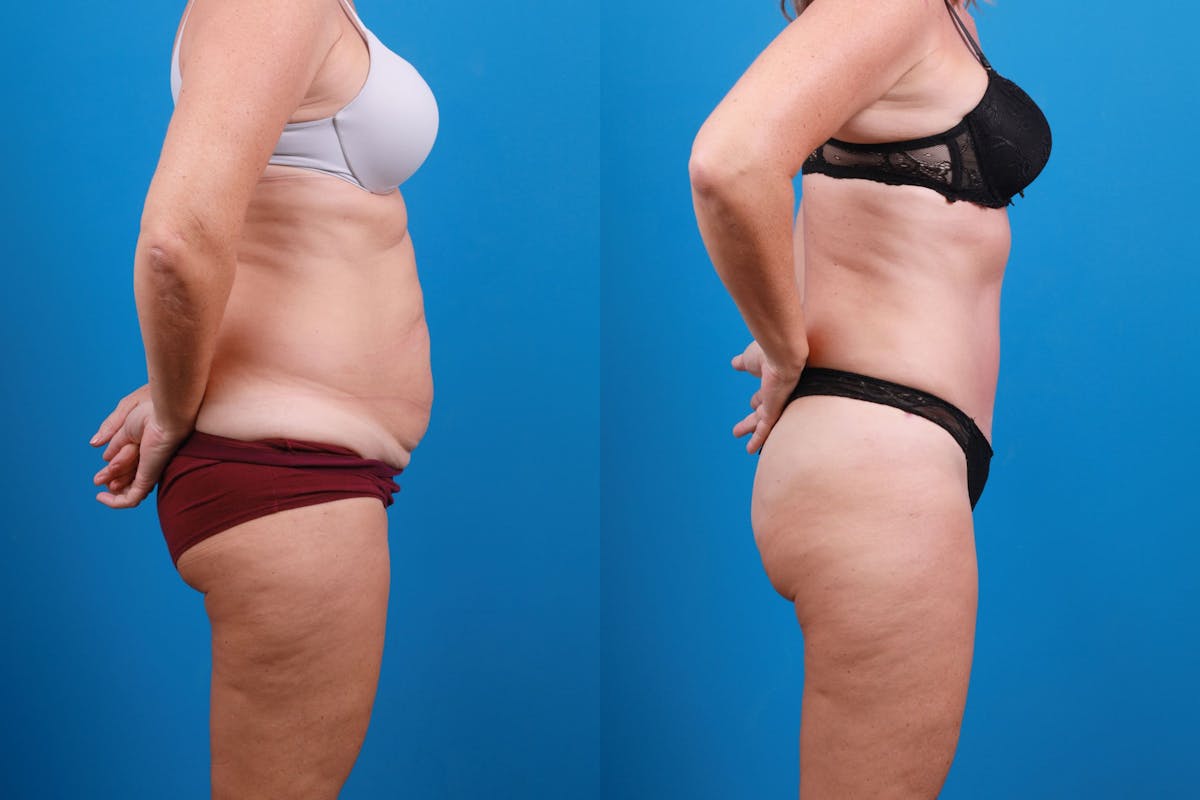 Tummy Tuck Before & After Gallery - Patient 139157 - Image 4