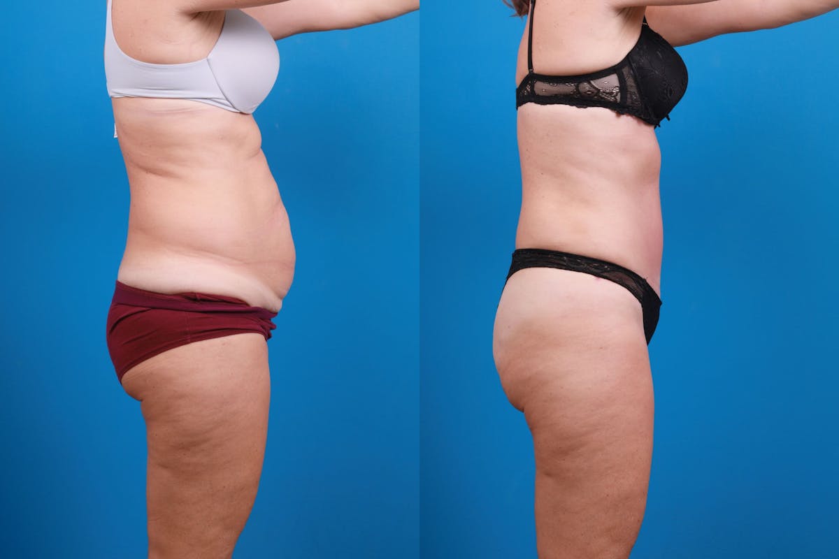 Tummy Tuck Before & After Gallery - Patient 147415881 - Image 5