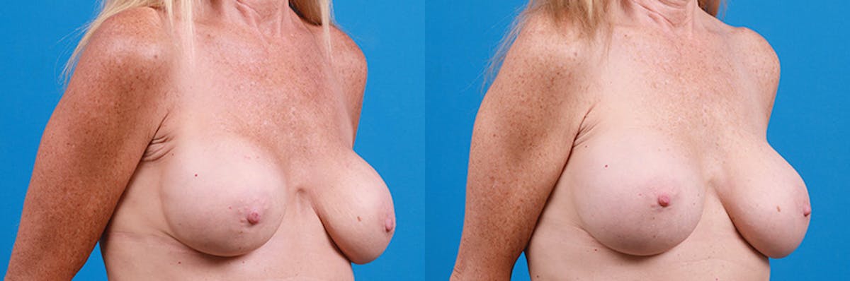 Breast Implant Exchange Before & After Gallery - Patient 219247 - Image 2