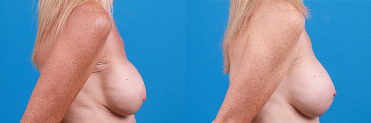 Breast Implant Exchange Before & After Gallery - Patient 219247 - Image 3