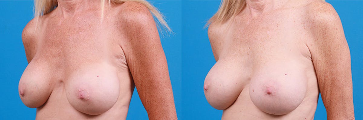 Breast Implant Exchange Before & After Gallery - Patient 219247 - Image 4
