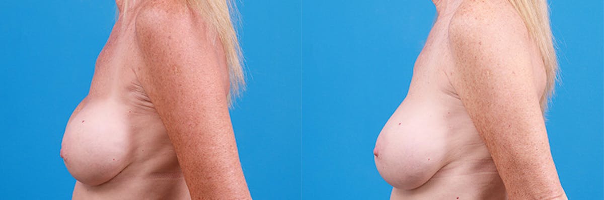 Breast Implant Exchange Before & After Gallery - Patient 219247 - Image 5