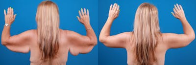 Arm Lift Before & After Gallery - Patient 147493638 - Image 1