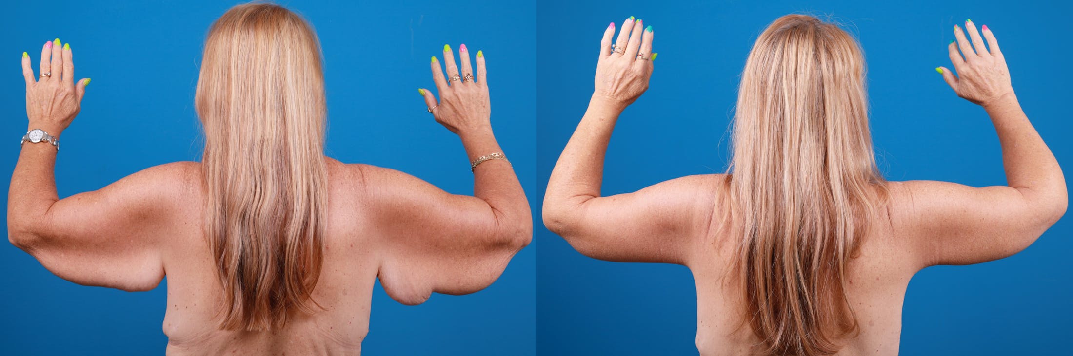 Arm Lift Before & After Gallery - Patient 147493638 - Image 1