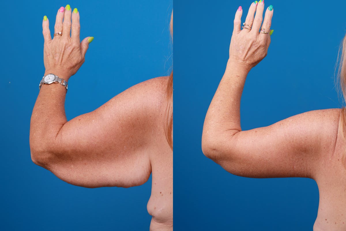 Arm Lift Before & After Gallery - Patient 147493638 - Image 2