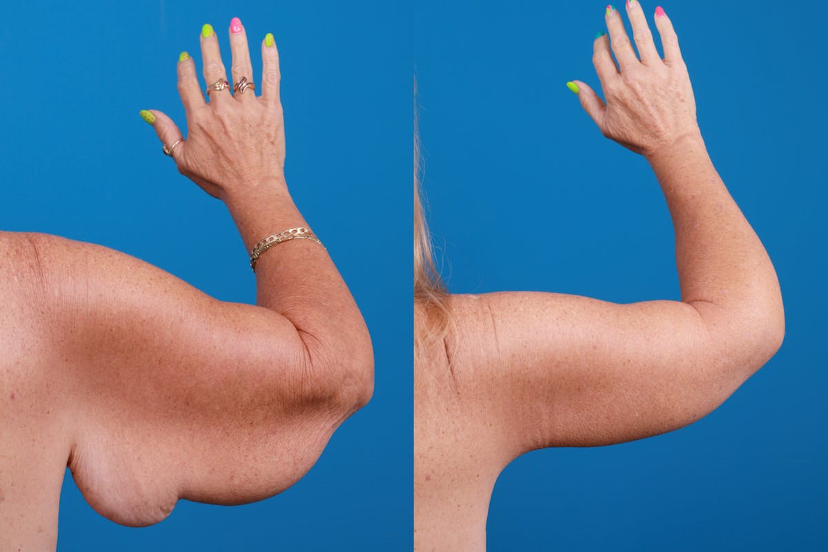 Arm Lift Before & After Gallery - Patient 147493638 - Image 3
