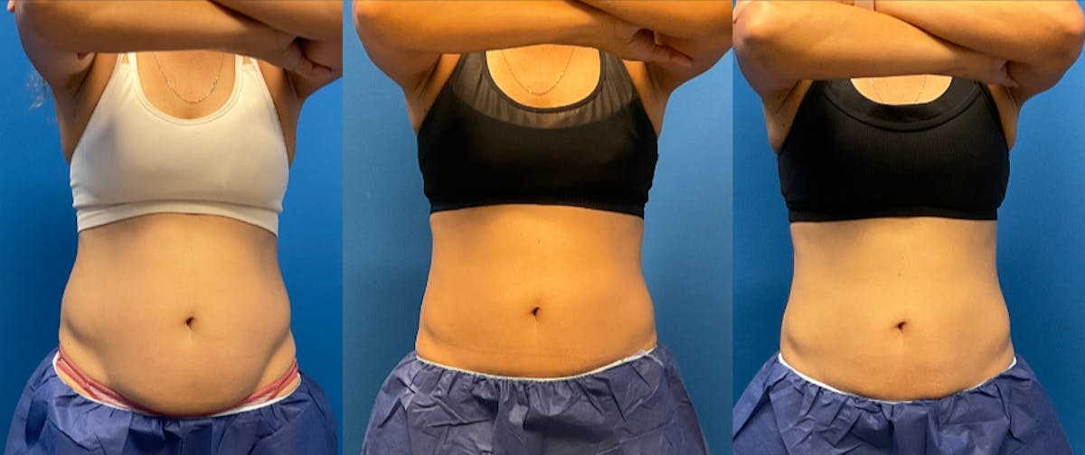 CoolSculpting ELITE results at Clevens Face & Body Specialists in Florida