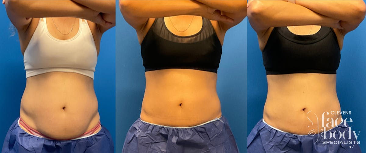 CoolSculpting ELITE results at Clevens Face & Body Specialists in Florida