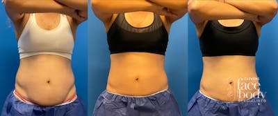 CoolSculpting ELITE results at Clevens Face & Body Specialists in Florida