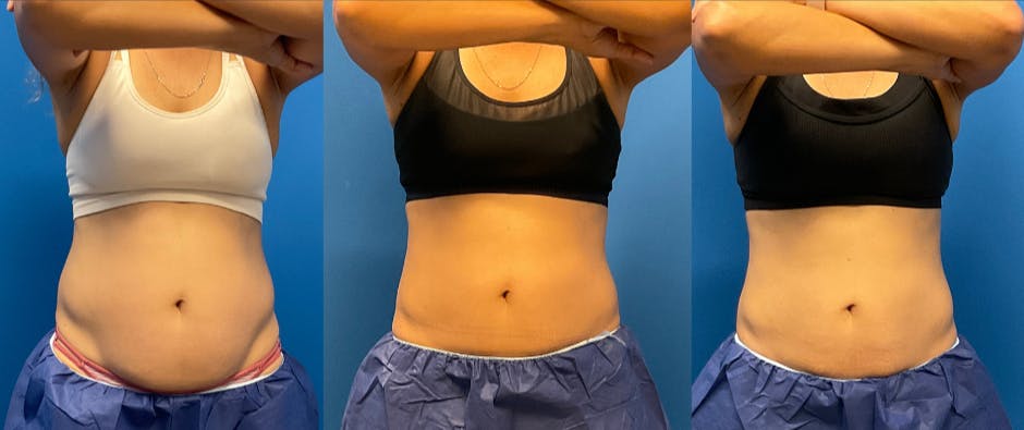 CoolSculpting Before & After Gallery - Patient 147416944 - Image 1