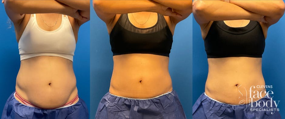 CoolSculpting ELITE results at Clevens Face & Body Specialists in Florida