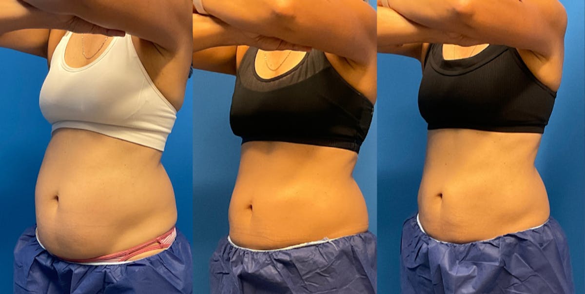 CoolSculpting ELITE results at Clevens Face & Body Specialists in Florida
