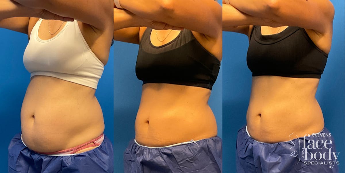 CoolSculpting ELITE results at Clevens Face & Body Specialists in Florida