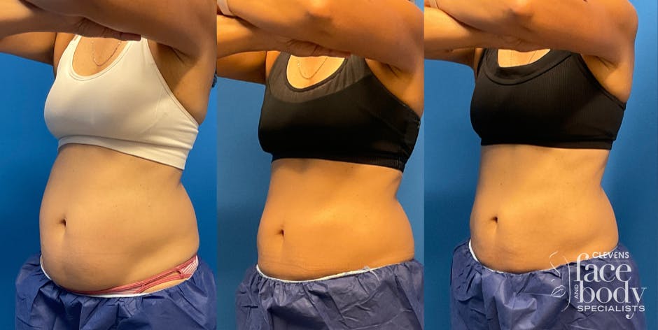 CoolSculpting ELITE results at Clevens Face & Body Specialists in Florida