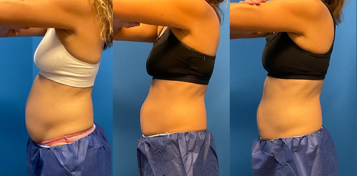 CoolSculpting ELITE results at Clevens Face & Body Specialists in Florida