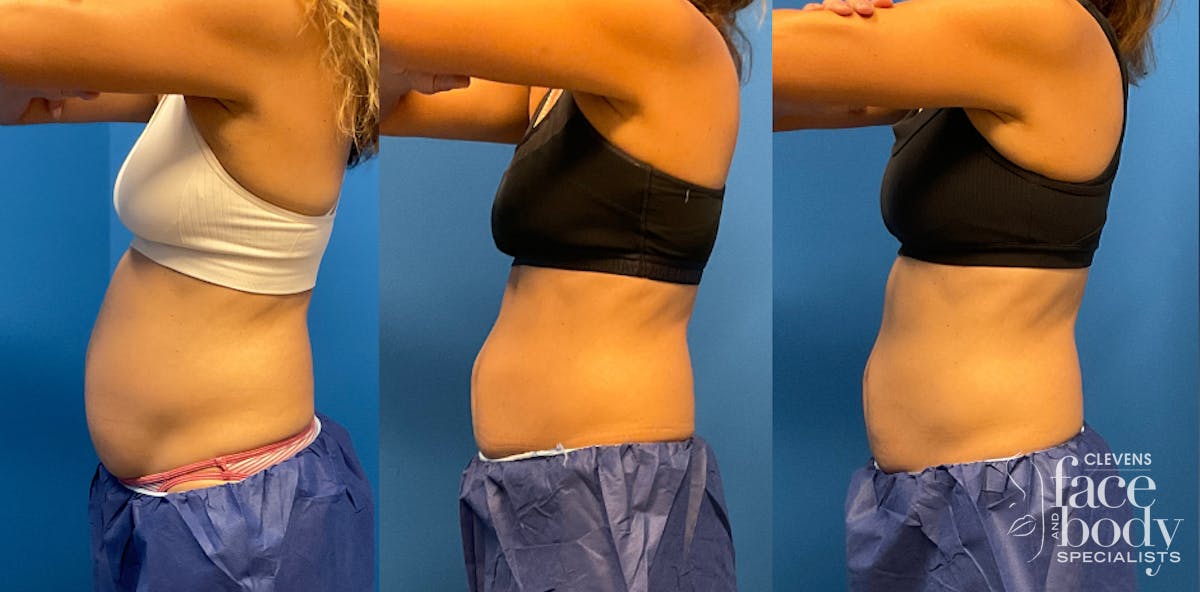 CoolSculpting ELITE results at Clevens Face & Body Specialists in Florida