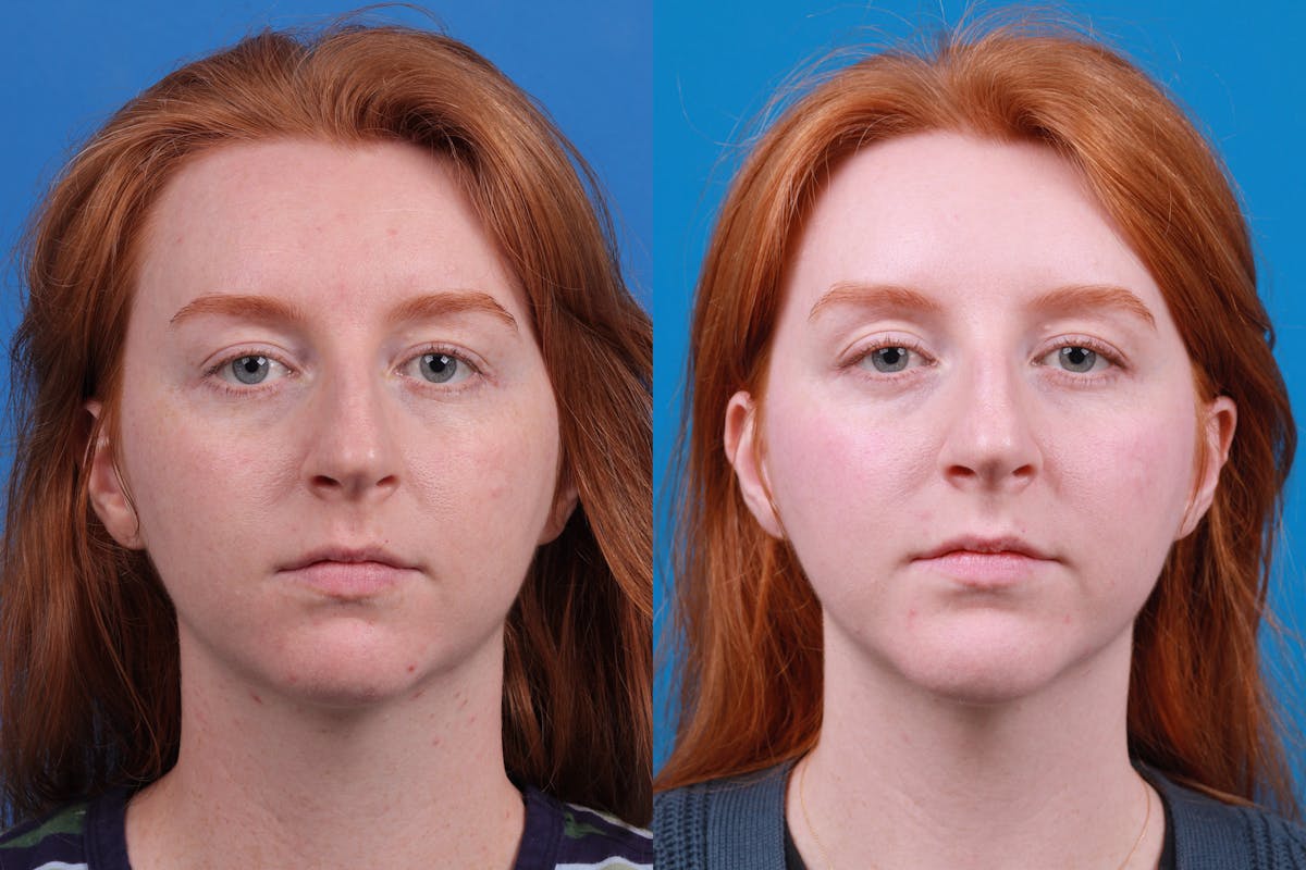 Chin Augmentation Before & After Gallery - Patient 148036739 - Image 3
