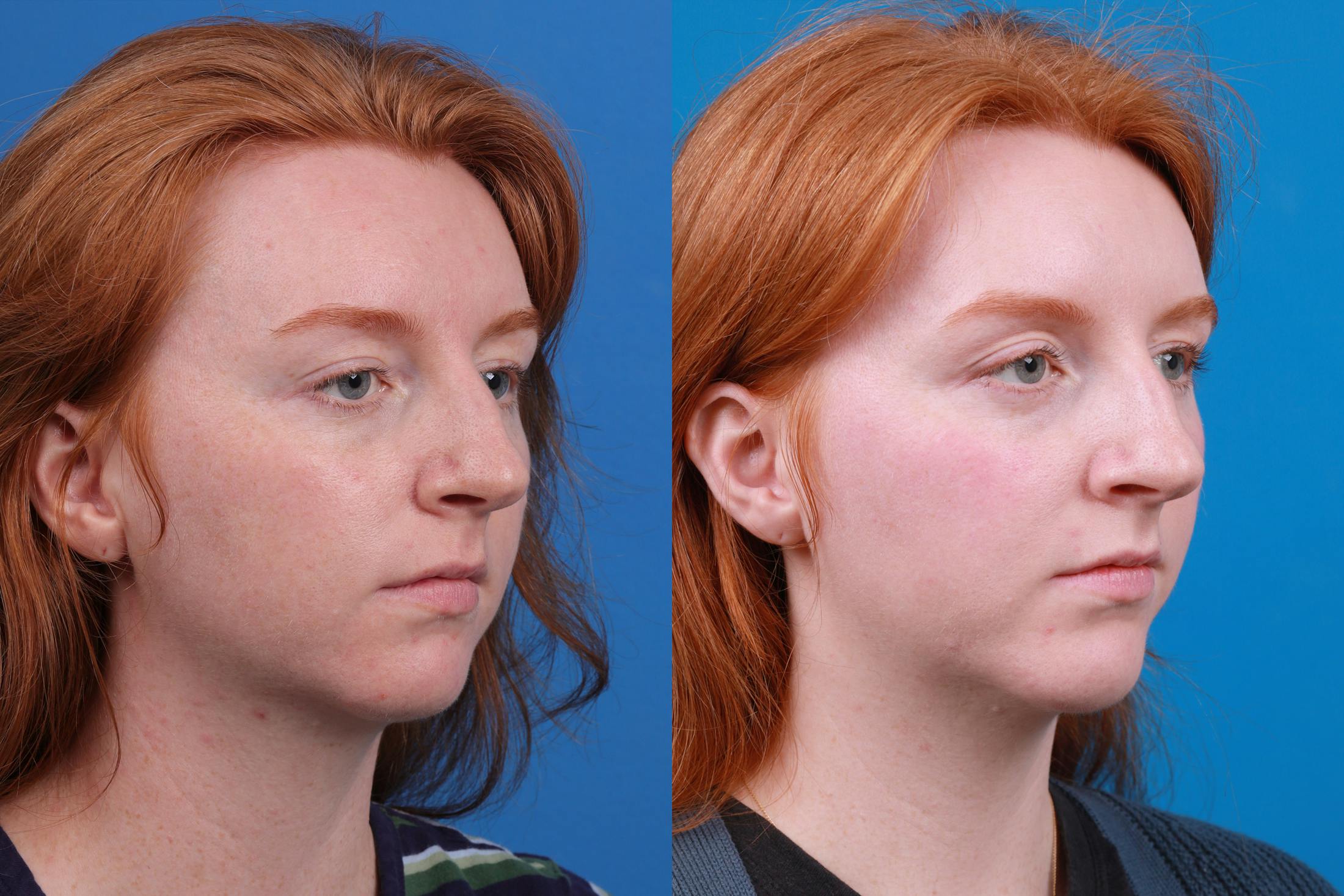 Chin Augmentation Before & After Gallery - Patient 148036739 - Image 4