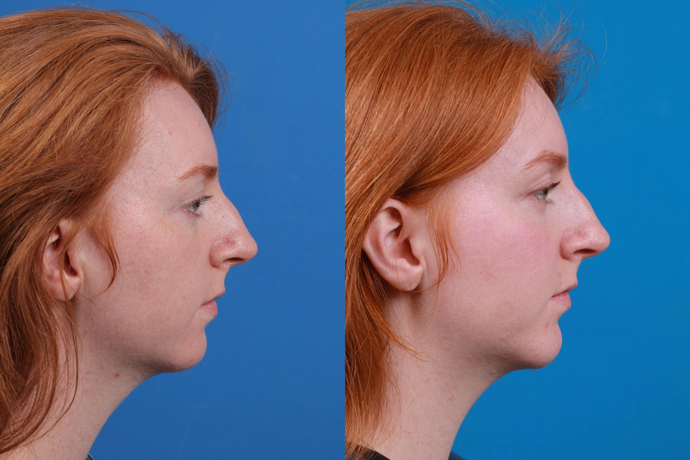 Chin Augmentation Before & After Gallery - Patient 148036739 - Image 5