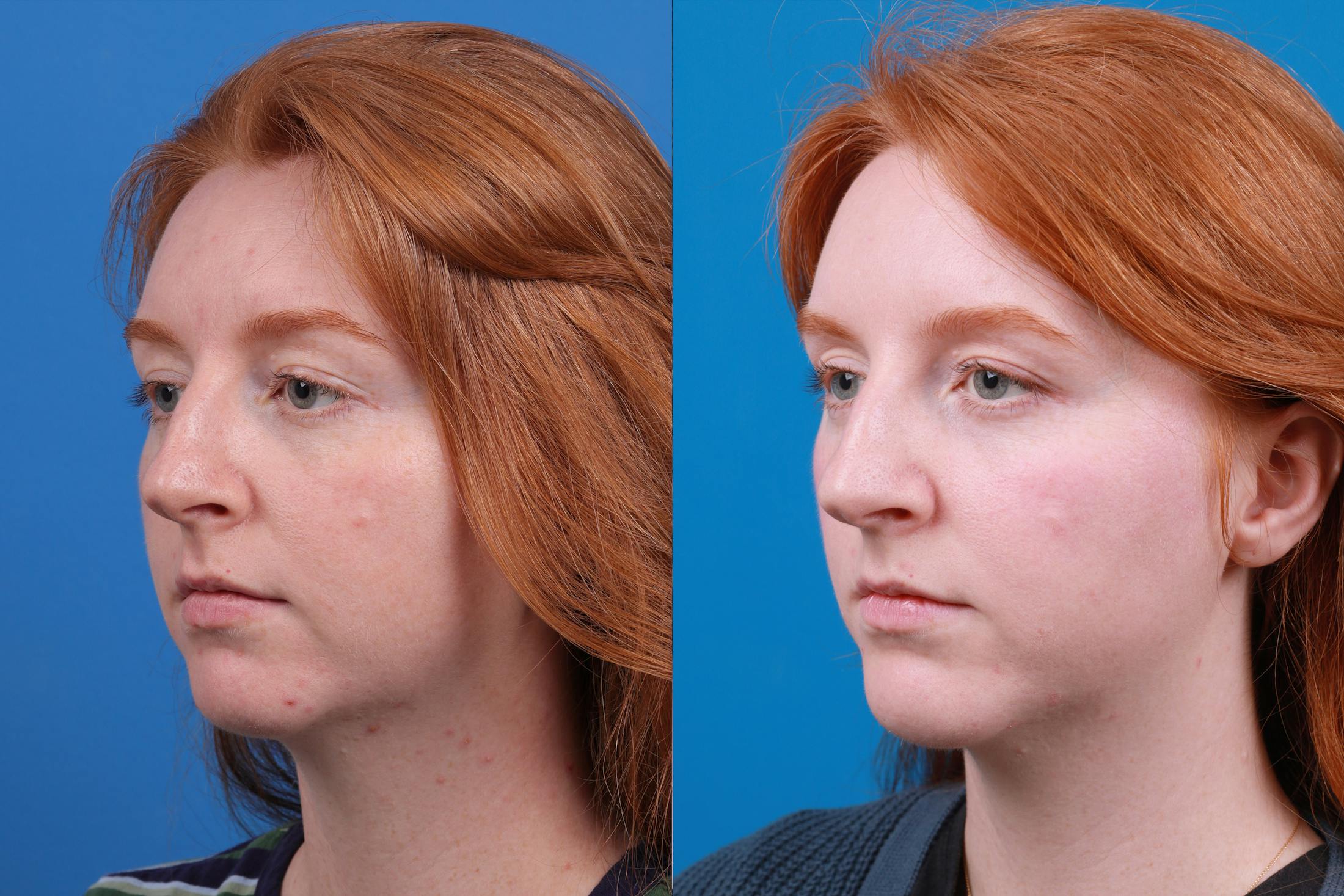 Chin Augmentation Before & After Gallery - Patient 148036739 - Image 2