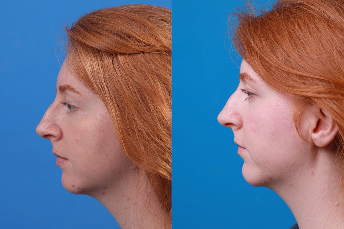 Chin Augmentation Before & After Gallery - Patient 148036739 - Image 1