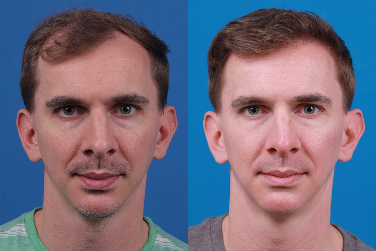 Hair Restoration Before & After Gallery - Patient 148147311 - Image 1