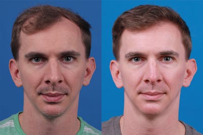 Hair Restoration Before & After Gallery - Patient 148147311 - Image 1