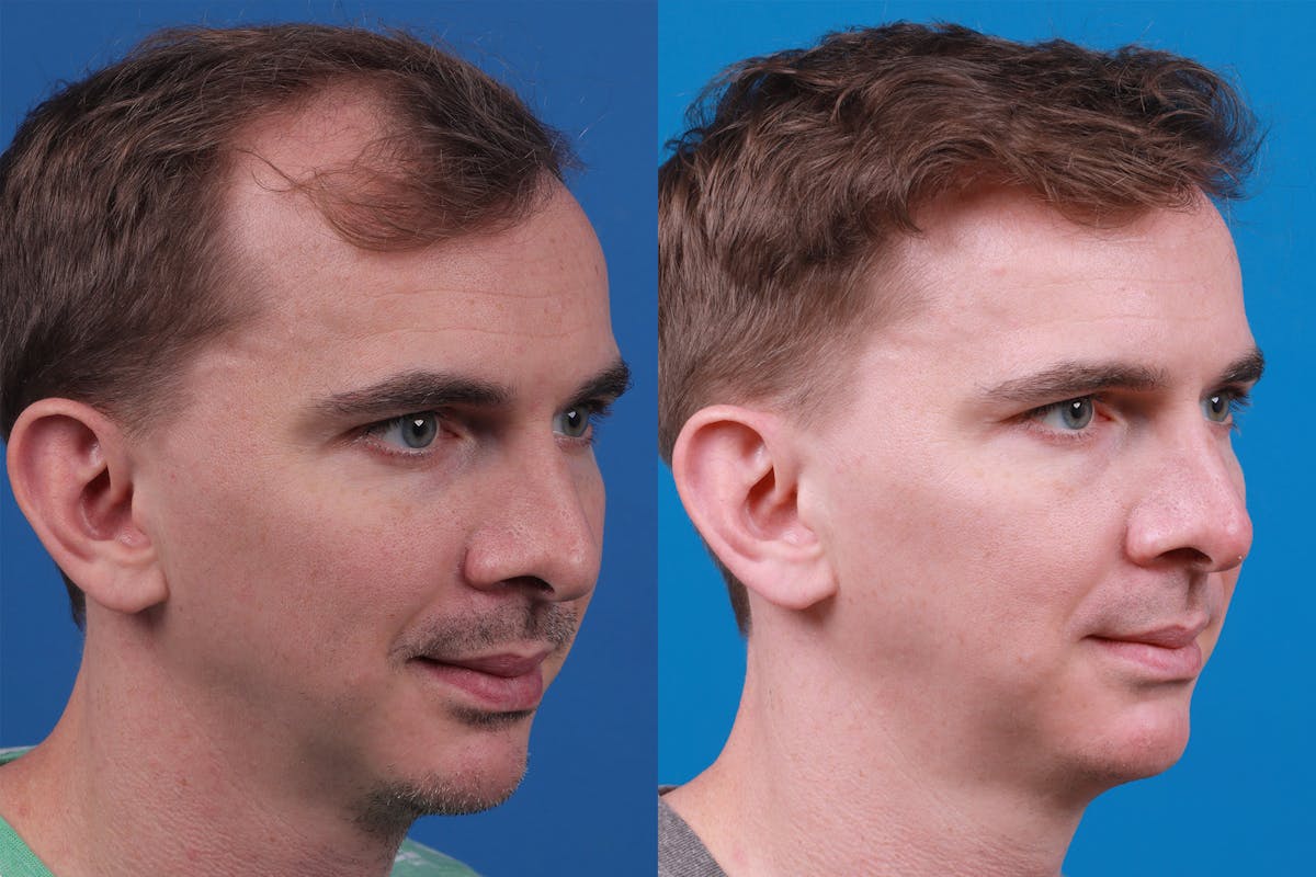 Hair Restoration Before & After Gallery - Patient 148147311 - Image 2