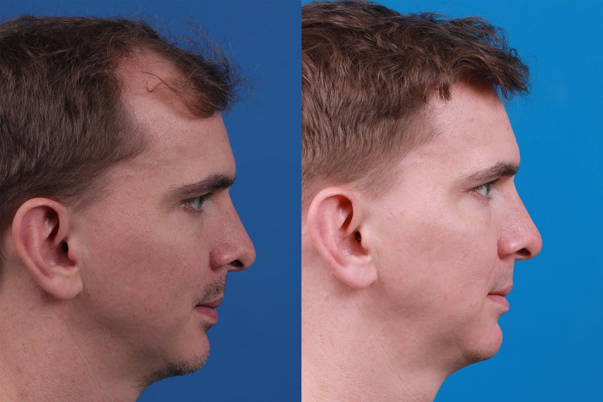 Hair Restoration Before & After Gallery - Patient 148147311 - Image 3
