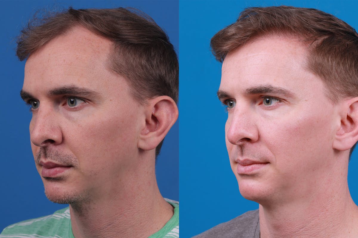 Hair Restoration Before & After Gallery - Patient 148147311 - Image 4