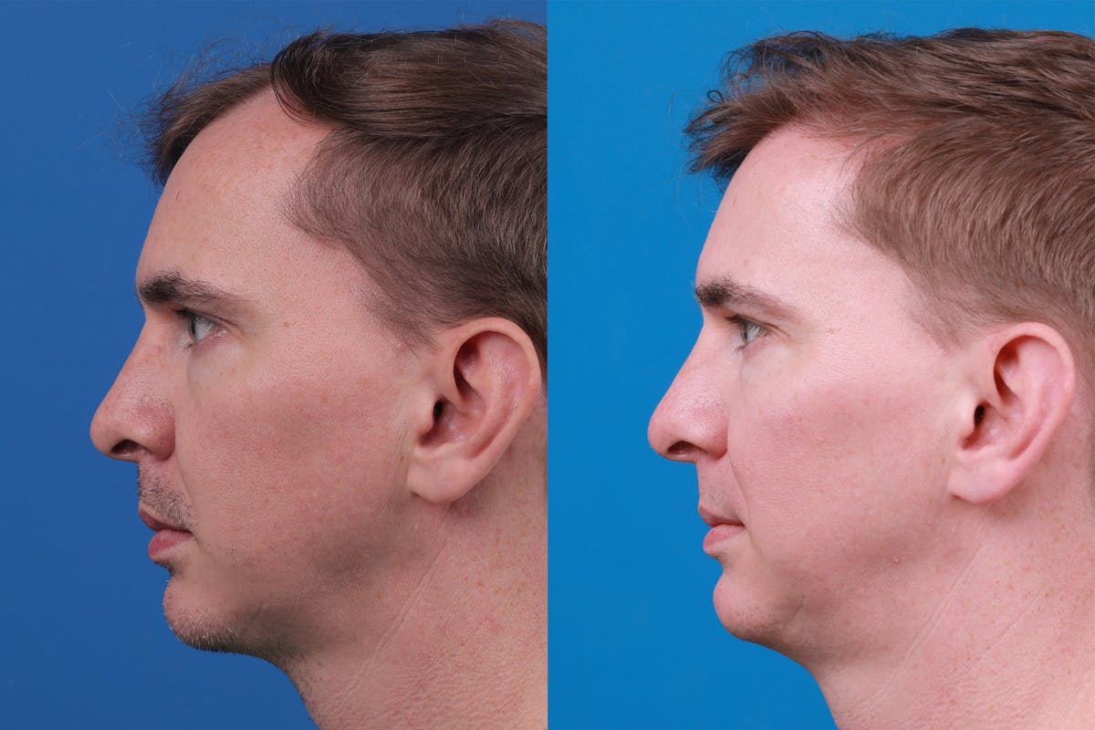 Hair Restoration Before & After Gallery - Patient 148147311 - Image 5
