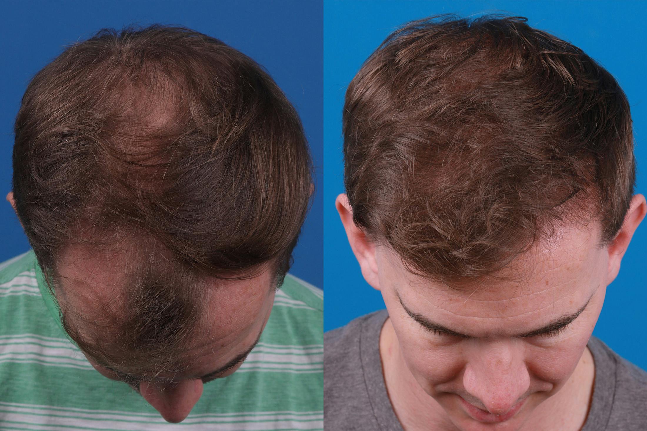 Hair Restoration Before & After Gallery - Patient 148147311 - Image 6
