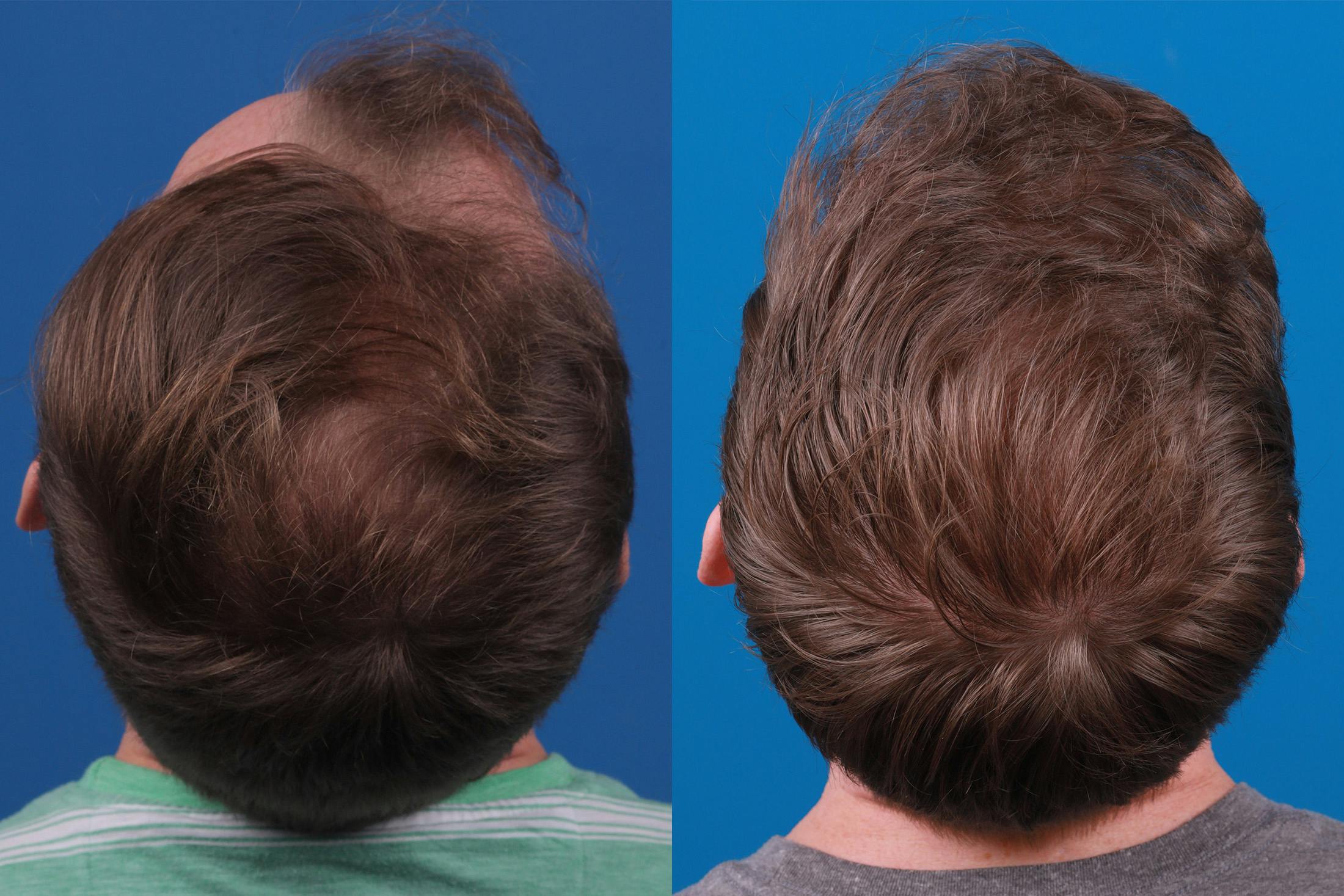 Hair Restoration Before & After Gallery - Patient 148147311 - Image 7