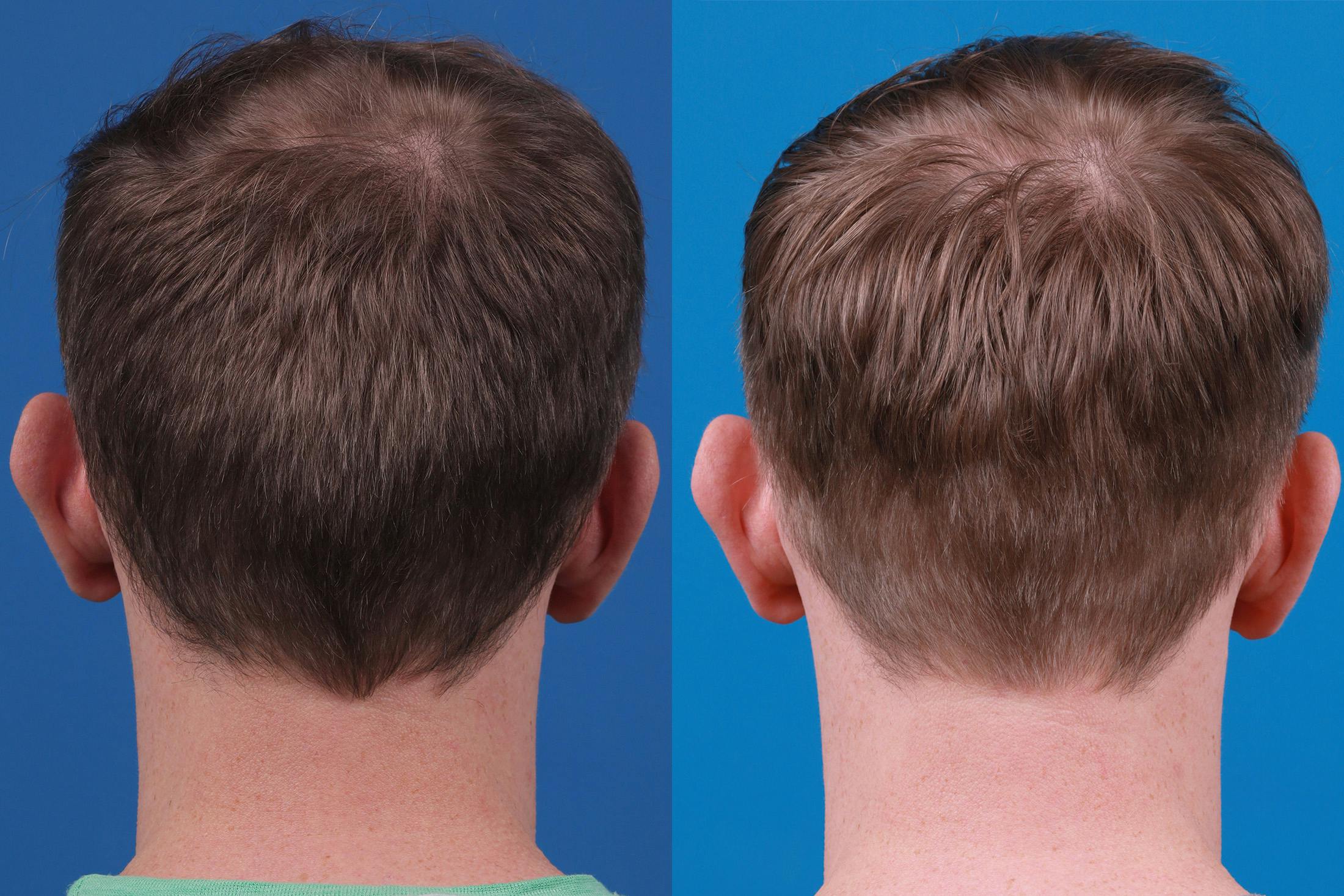 Hair Restoration Before & After Gallery - Patient 148147311 - Image 8