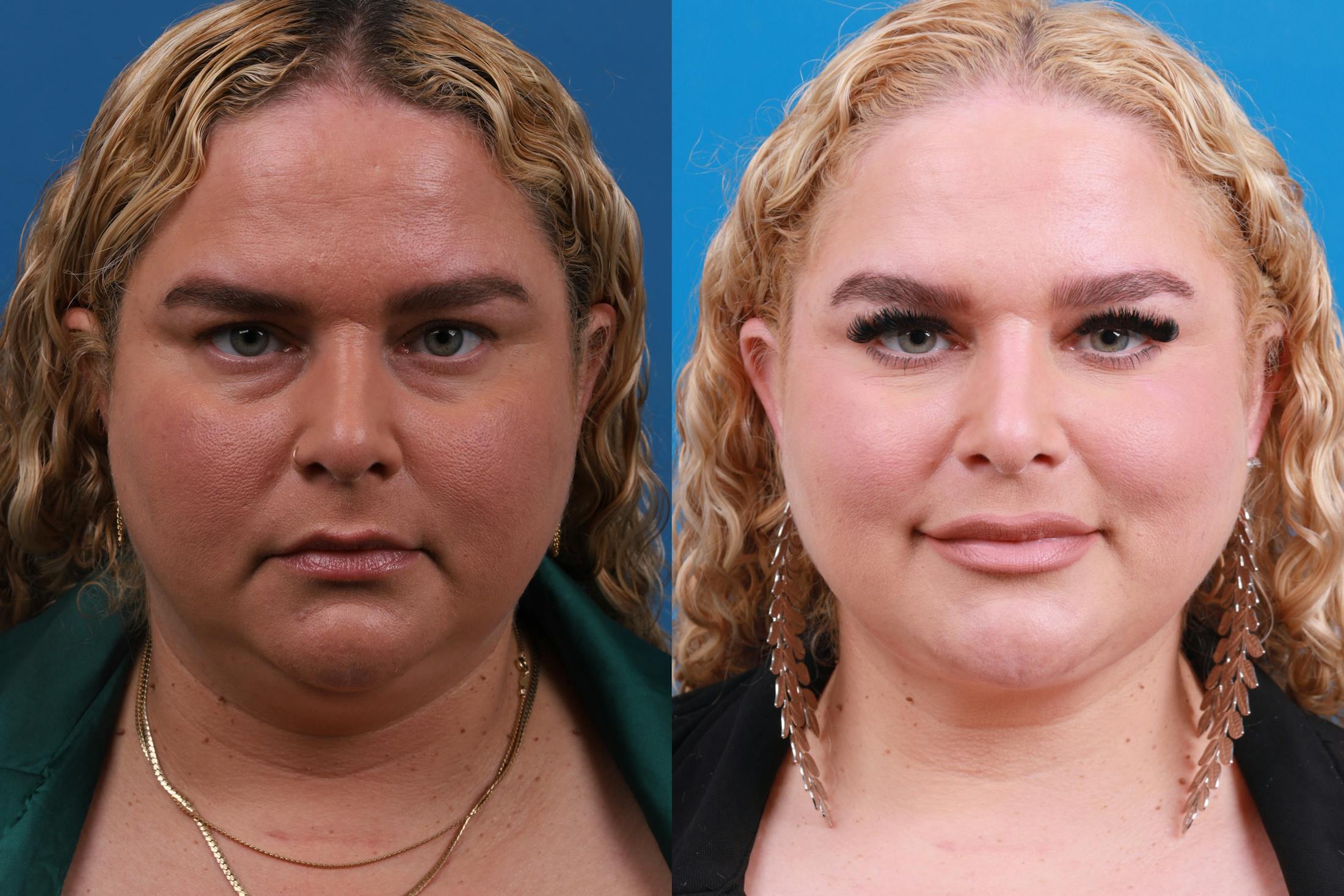 Express Lift Before & After Gallery - Patient 148147316 - Image 1