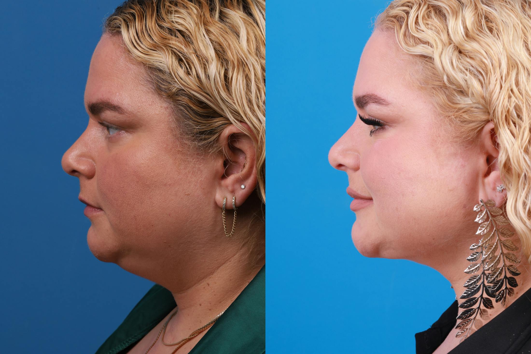 Express Lift Before & After Gallery - Patient 148147316 - Image 2