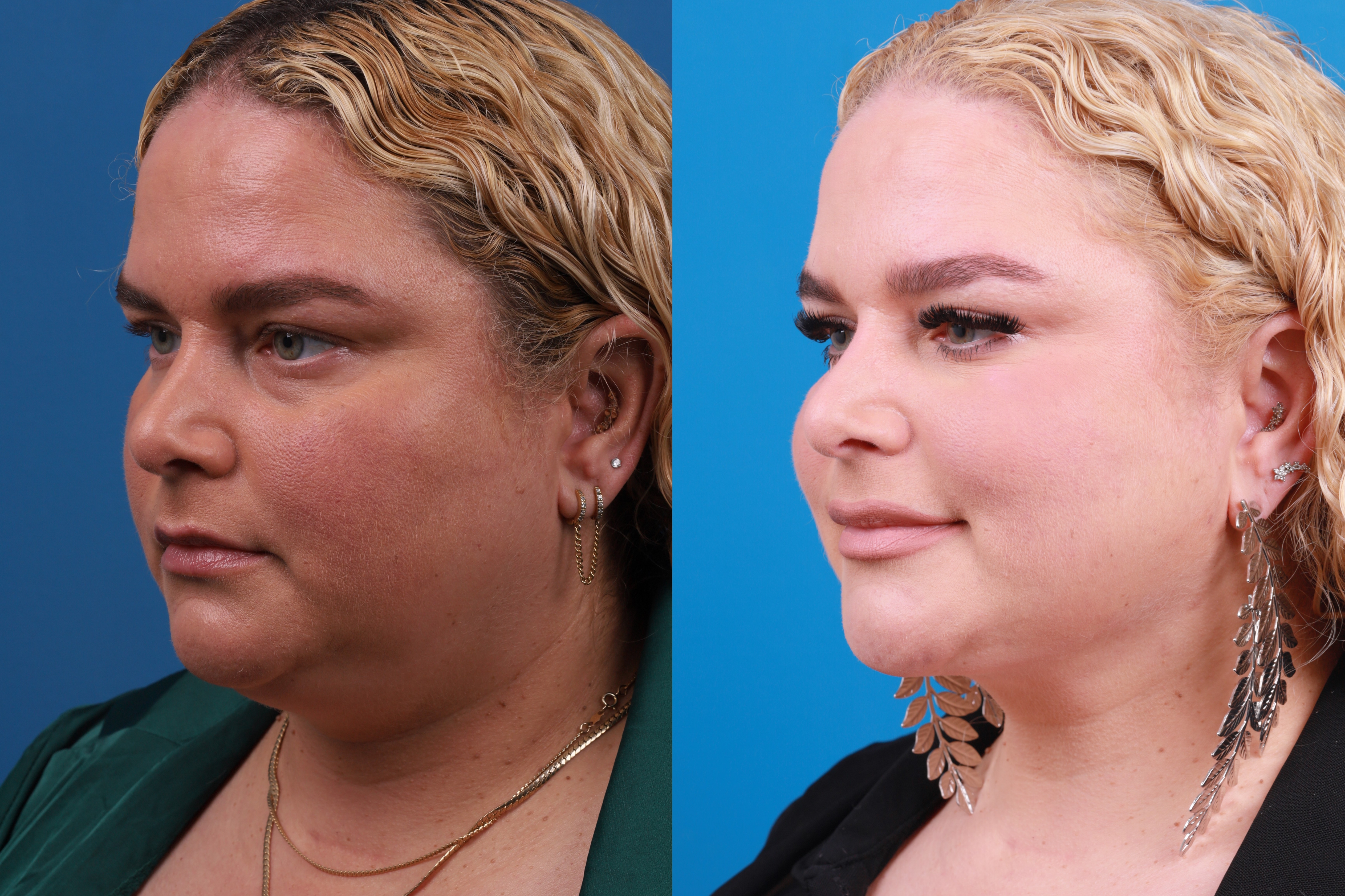 Express Lift Before & After Gallery - Patient 148147316 - Image 3