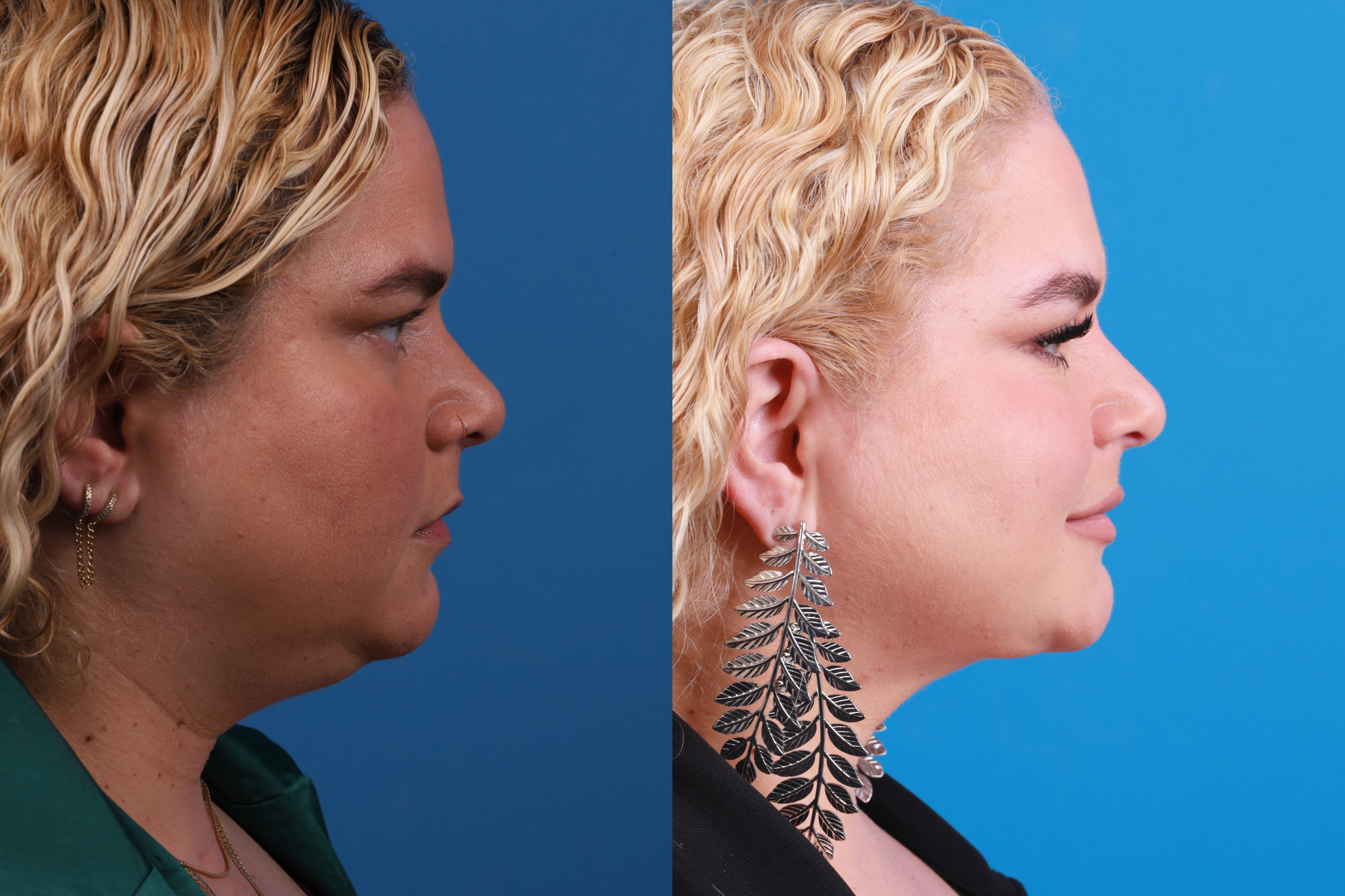 Express Lift Before & After Gallery - Patient 148147316 - Image 4