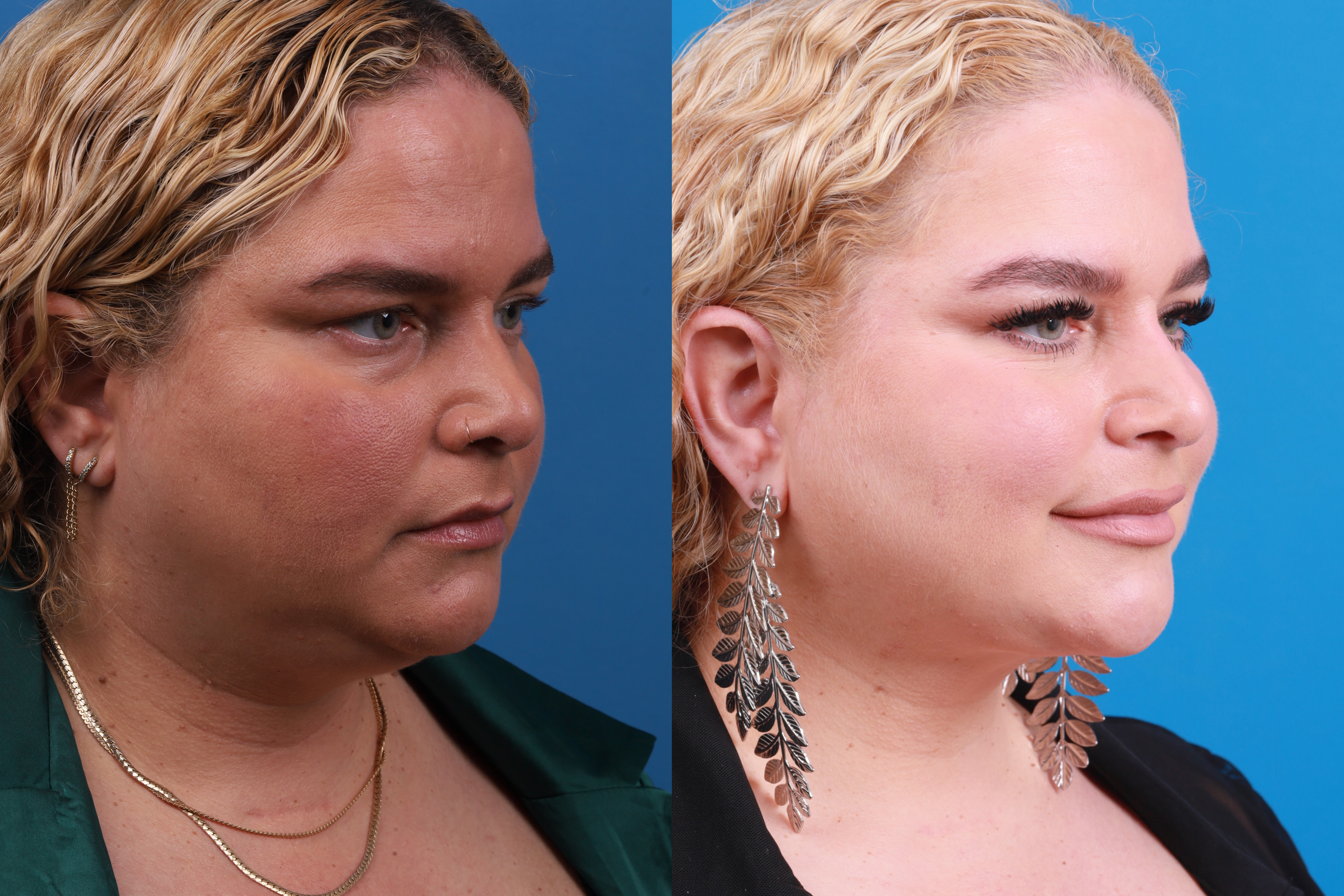 Express Lift Before & After Gallery - Patient 148147316 - Image 5