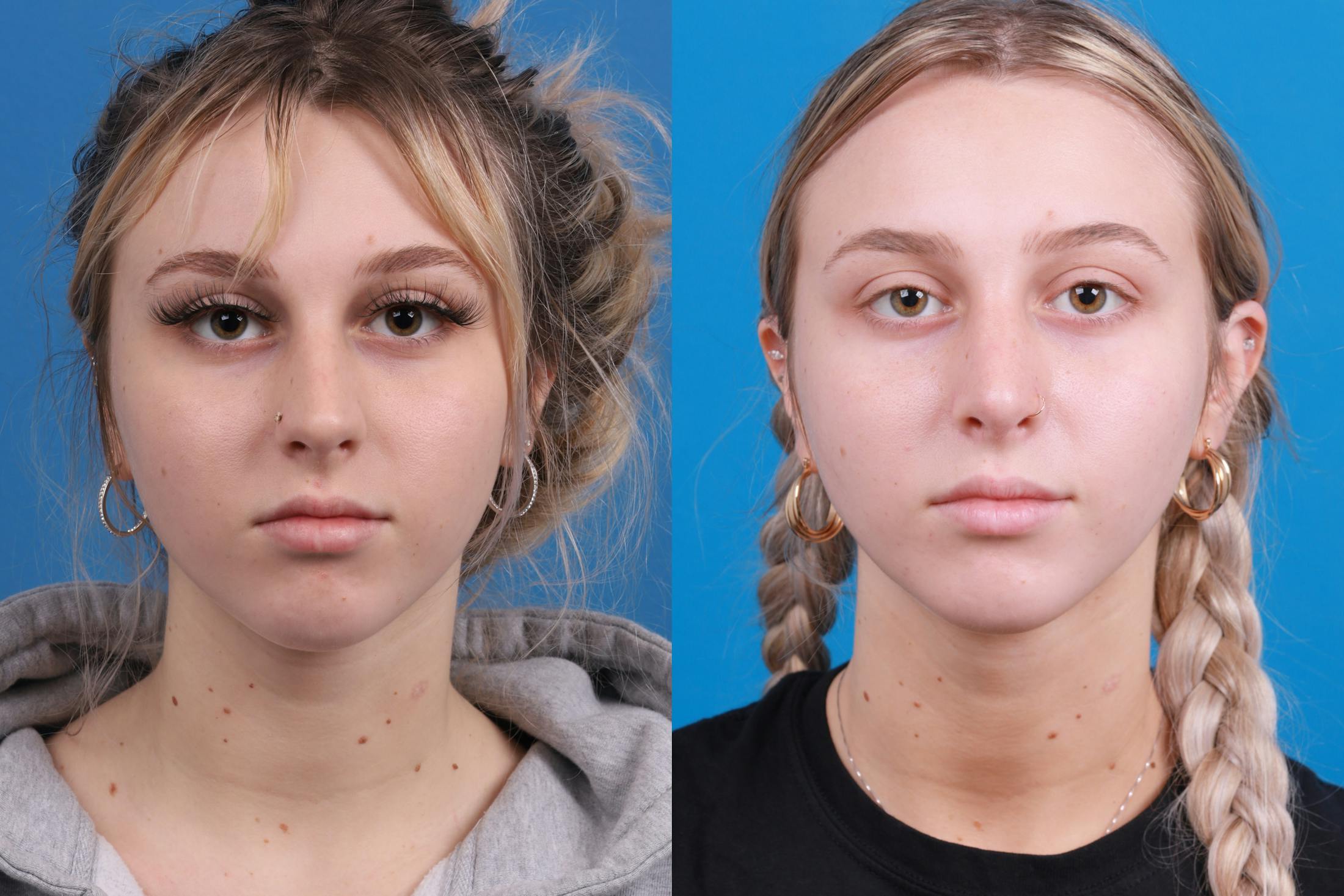 Rhinoplasty Before & After Gallery - Patient 148430547 - Image 1