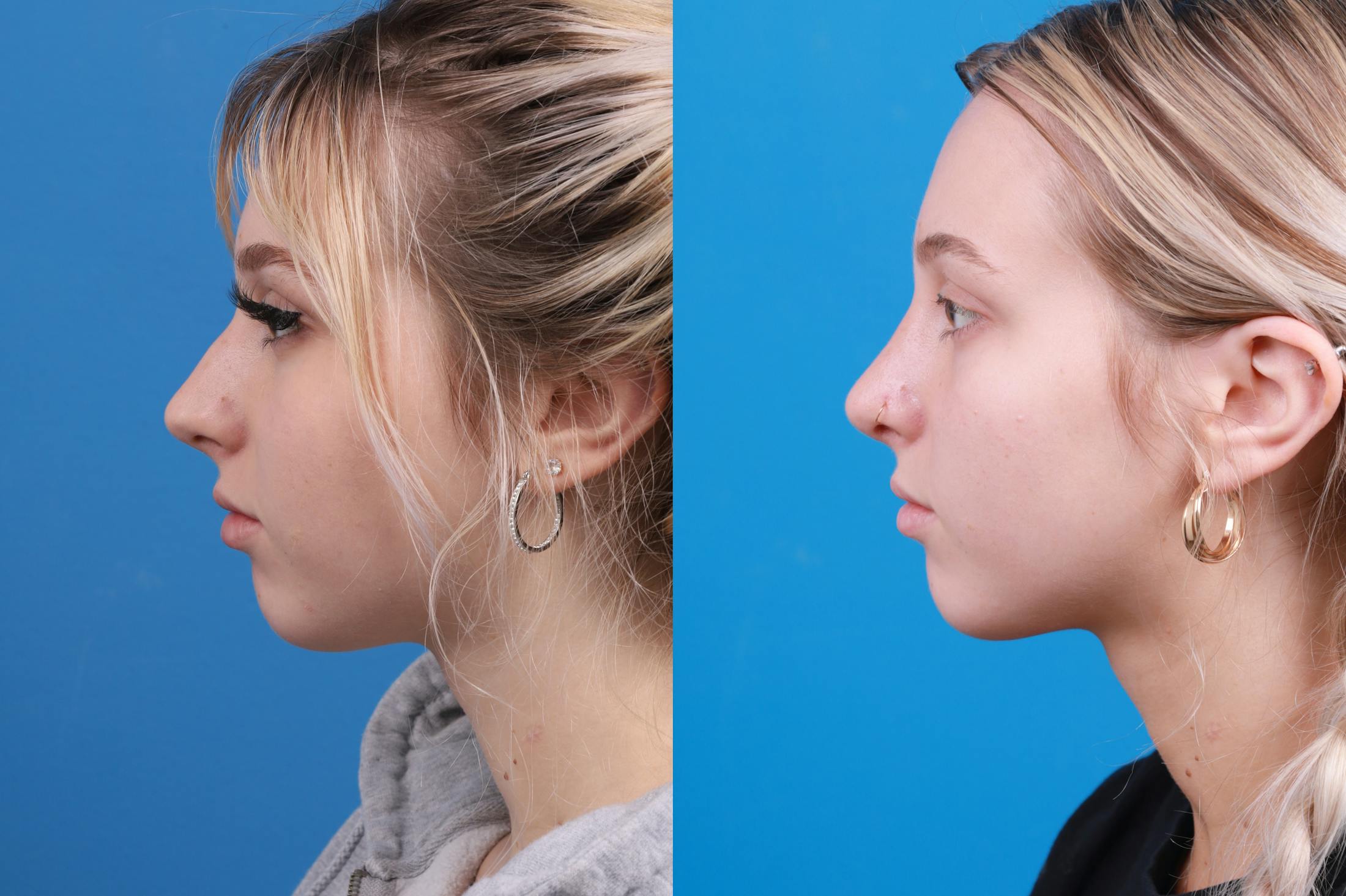 Rhinoplasty Before & After Gallery - Patient 148430547 - Image 2